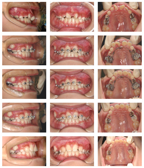 矯正治療 大阪府枚方市の歯医者